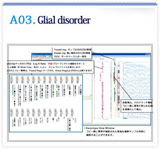 Glial disorder