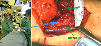 図Ⅴ-1-1（左）　顕微鏡で血管をつないでいるところ （右）　頸部の血管につないだ血管