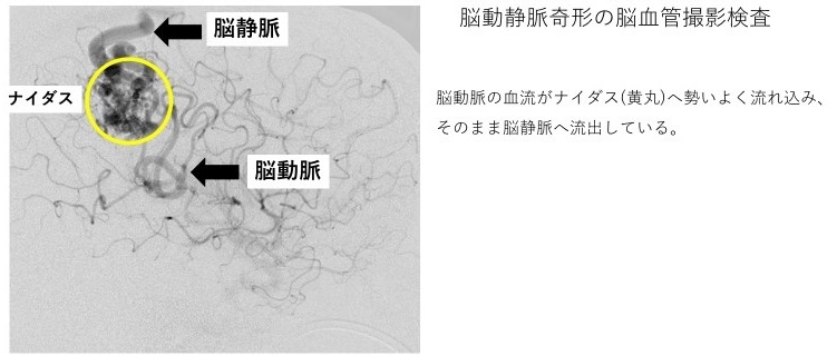 脳・脊髄動静脈奇形と頭蓋内・脊髄硬膜動静脈瘻 裁断済 melodiapet.com.br