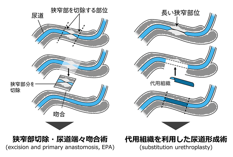 尿道狭窄の治療法にはどのようなものがあるのでしょうか?