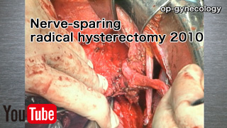 Nerve-sparing radical hysterectomy 2010(自律神経温存広汎子宮全摘術)