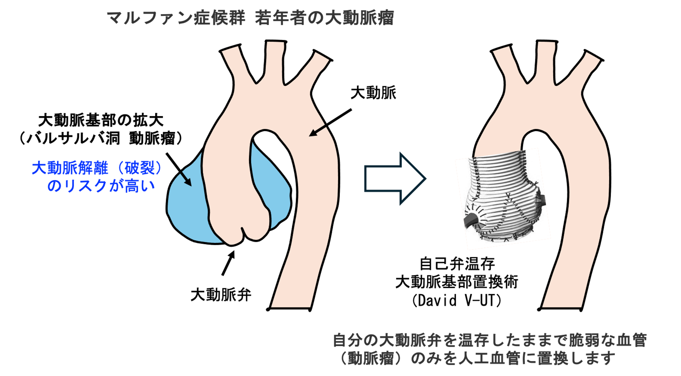 マル ファン 症候群