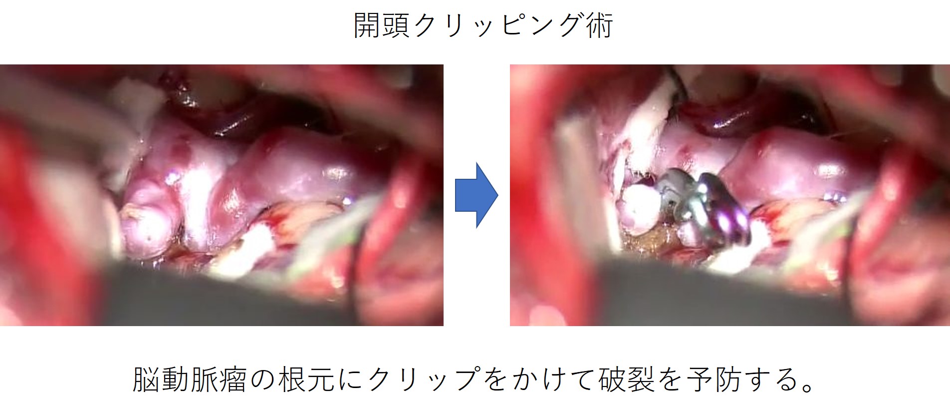 Neuroinfo Japan：未破裂脳動脈瘤