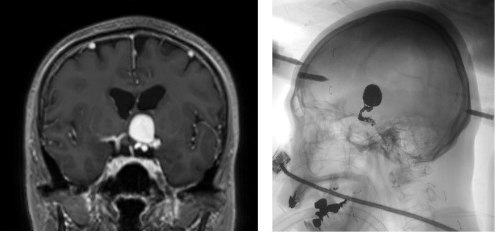 脳動脈瘤のコイル巻きは記憶力にどのような影響を与えるのでしょうか?