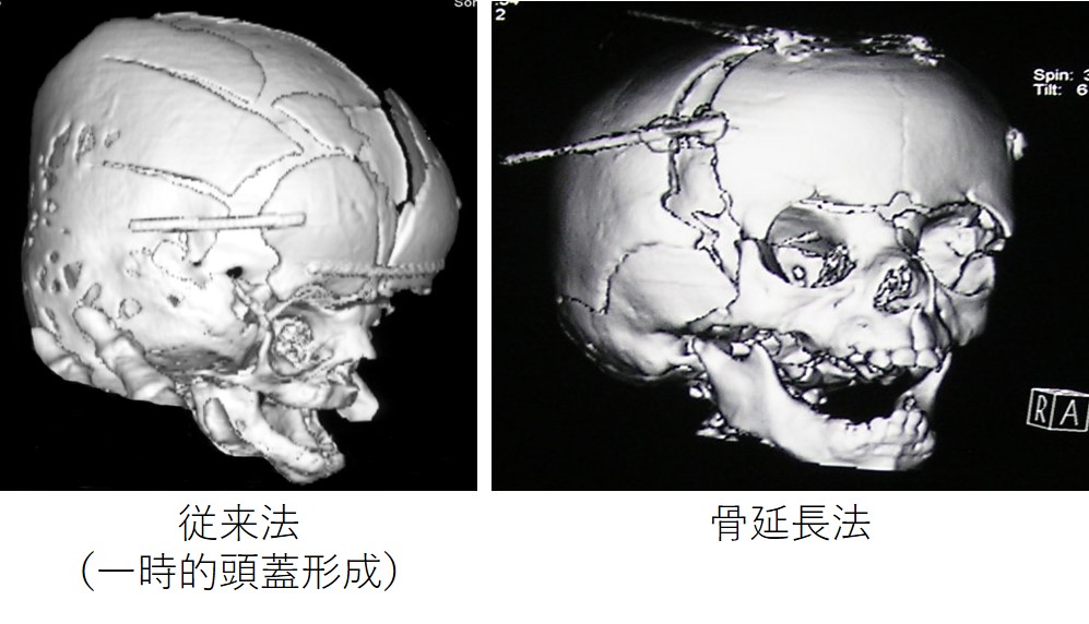 Neuroinfo Japan 頭蓋骨縫合早期癒合
