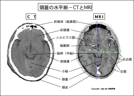 質 脳 灰白 てんかんの原因、皮質形成異常について
